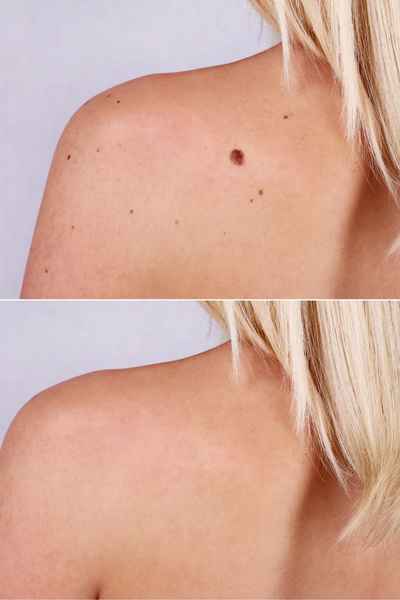 Why Does a Benign Mole Andover 	 Occur?