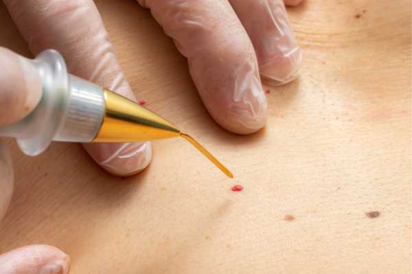 Cherry Angioma Removal Andover 	