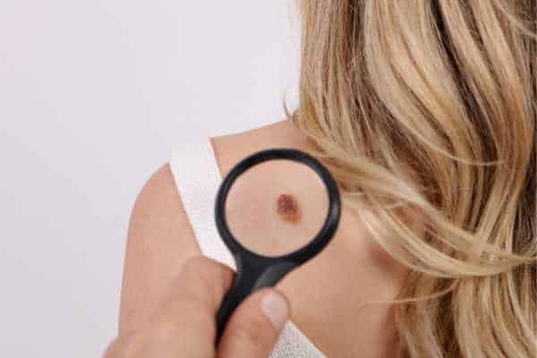 benign mole