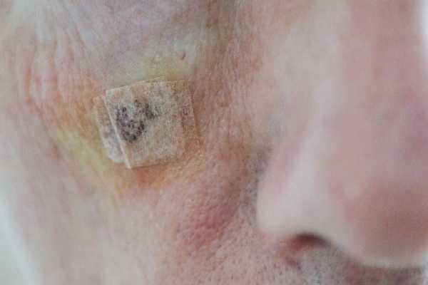 seborrheic keratoses removal Andover 	