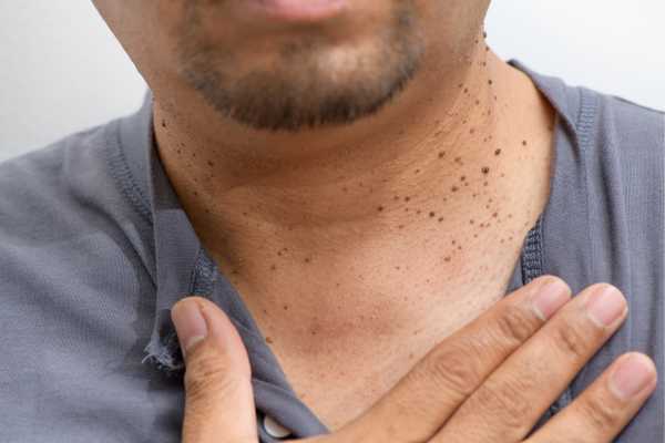 How Does Skin Tag Removal Andover 	 Work?