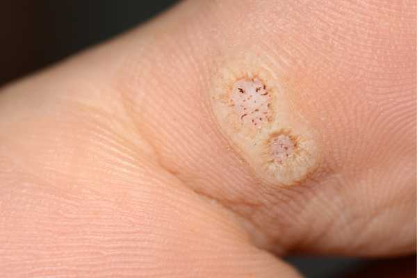 wart removal Andover 	