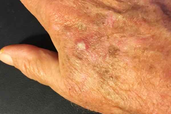 What Makes CryoPen a Safe Choice for Wart Removal Andover 	?