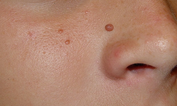 Angiofibromas Andover 	 Removal Treatment
