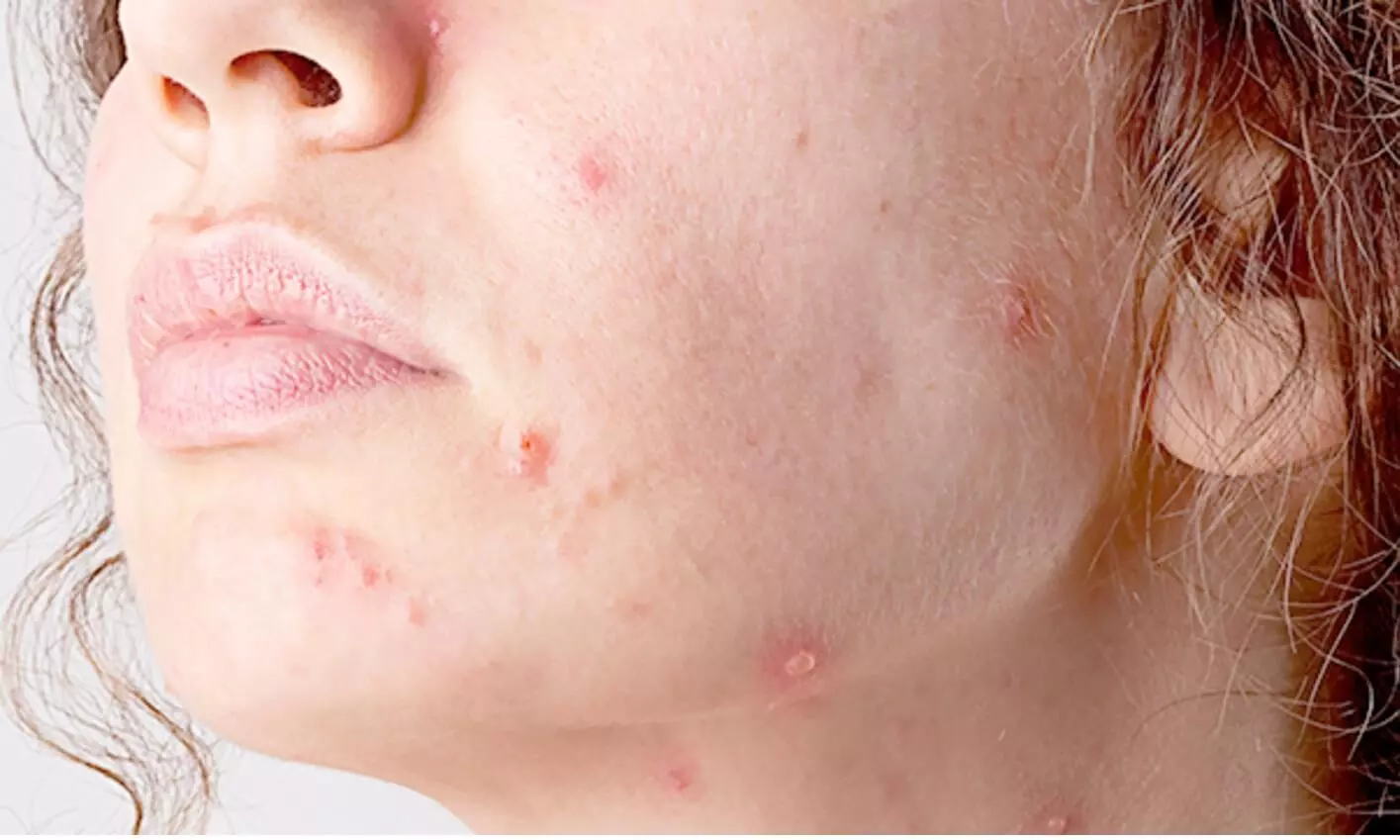 Porokeratosis Andover 	, How We Remove It