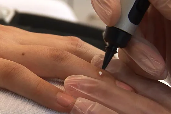 Porokeratosis Treatment Andover 	