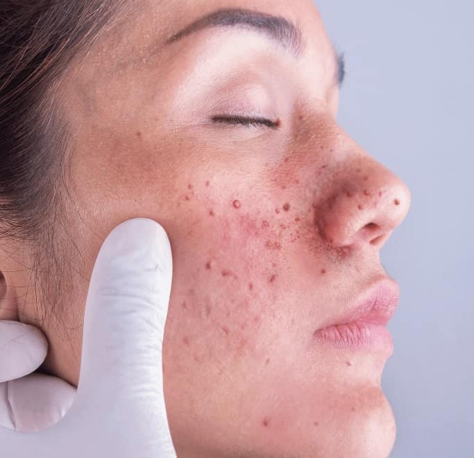 Angiofibroma Treatment Andover 	