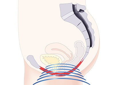 Pelvic-Floor Muscle Repair