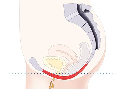 Pelvic floor muscles Andover 	