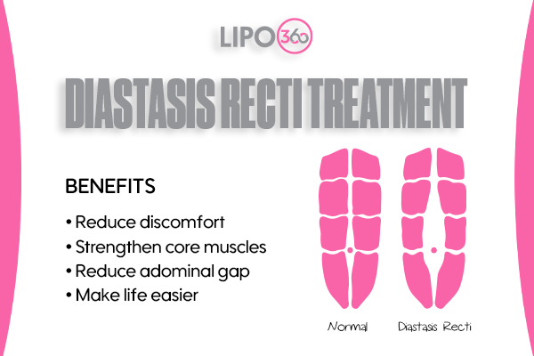 LIPO360 Body Sculpt - Diastasis Recti Treatment Andover 	