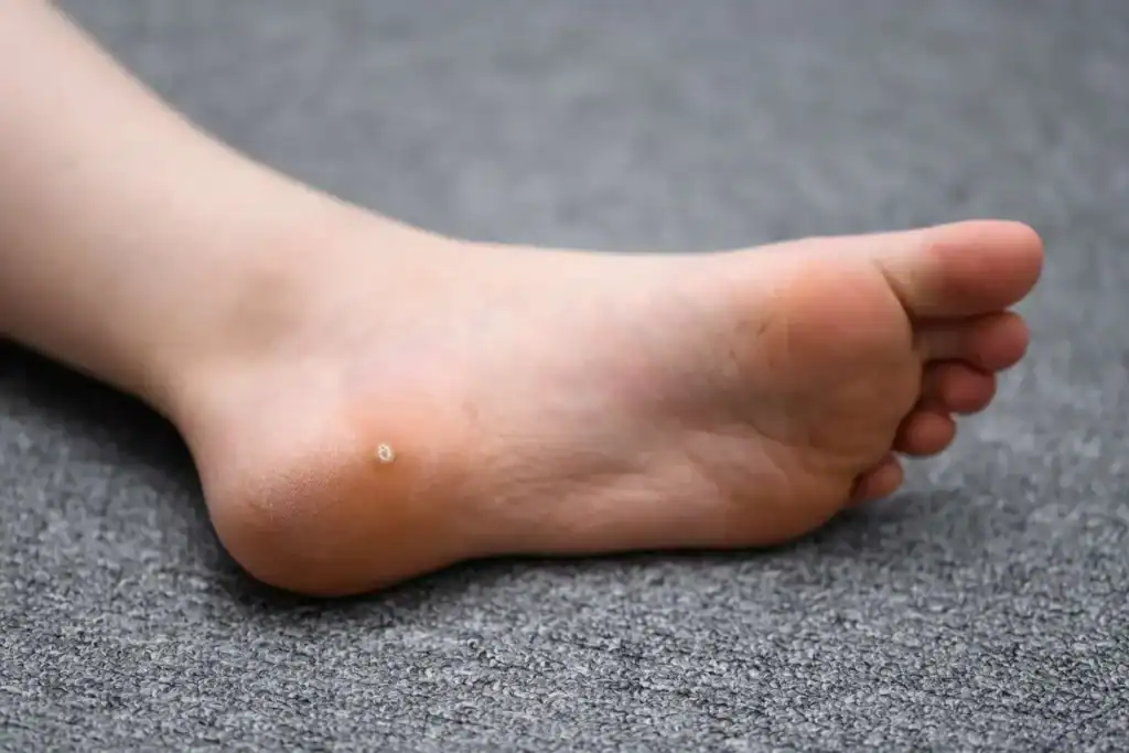 Image of verruca on the bottom of the foot that able to be treated with Cryotherapy Andover 	