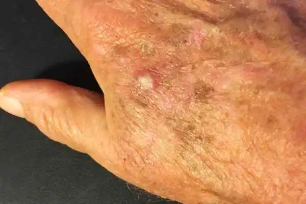 Image of Actinic keratoses Andover 	 on a person hand